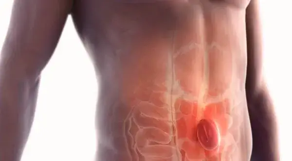Kiedy można ćwiczyć po operacji przepukliny pępkowej bez ryzyka?