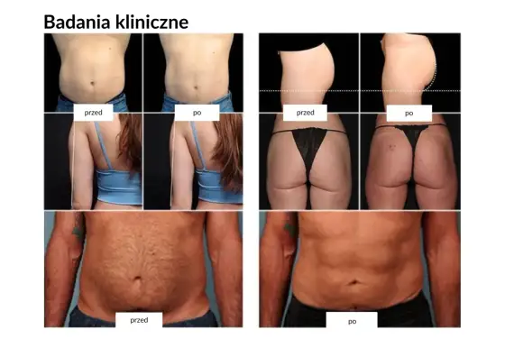 Trening EMS efekty przed i po - Co realnie zmienia się w sylwetce?